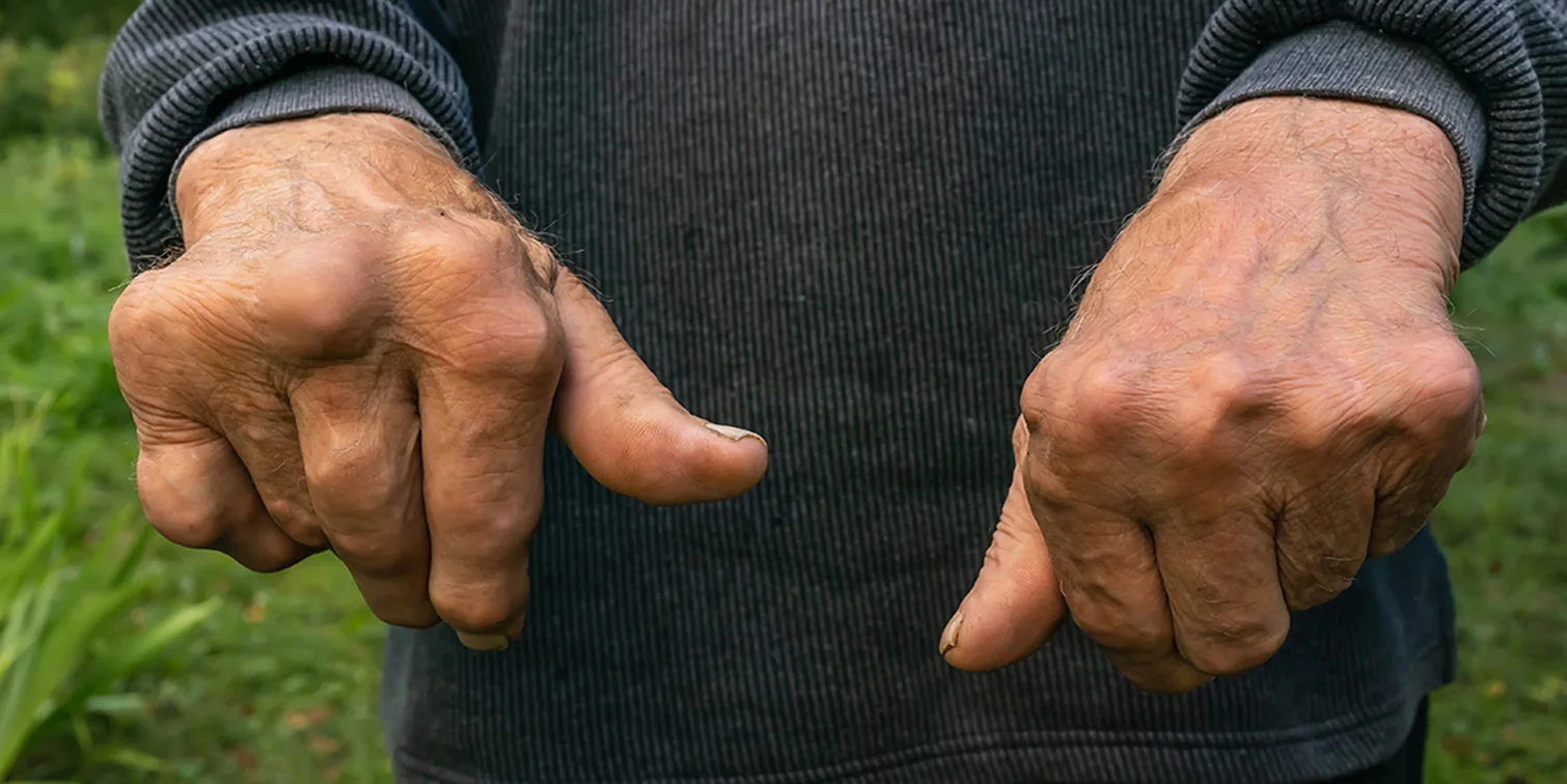 Arthritis Rheumatoid