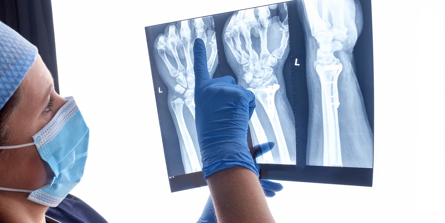 Non-Healing or Malunion Fractures might need surgery with Dr. Rod French