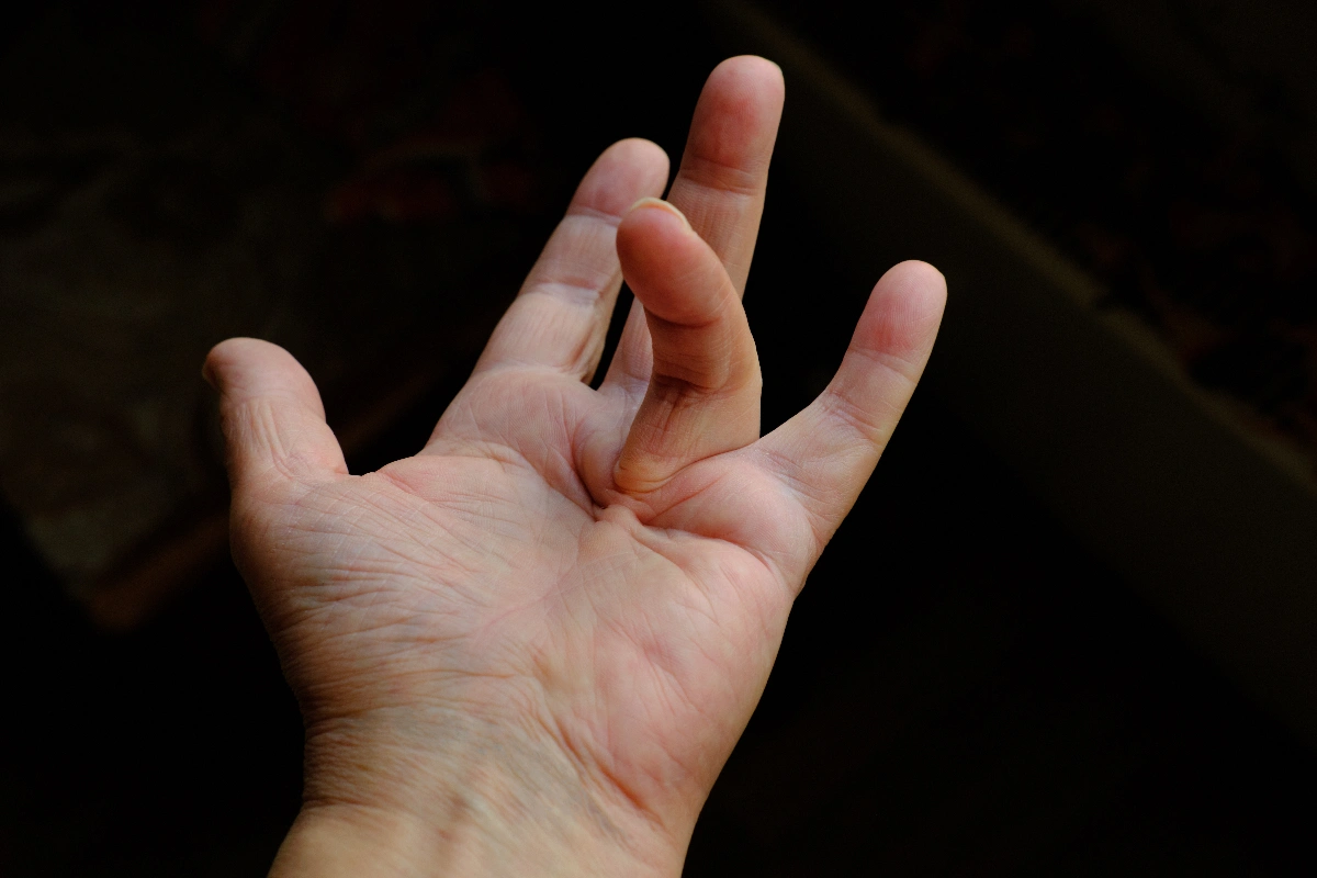 A hand is shown palm up with fingers curled slightly inward, set against a dimly lit background. The image shows an example of Dupuytren's Contracture