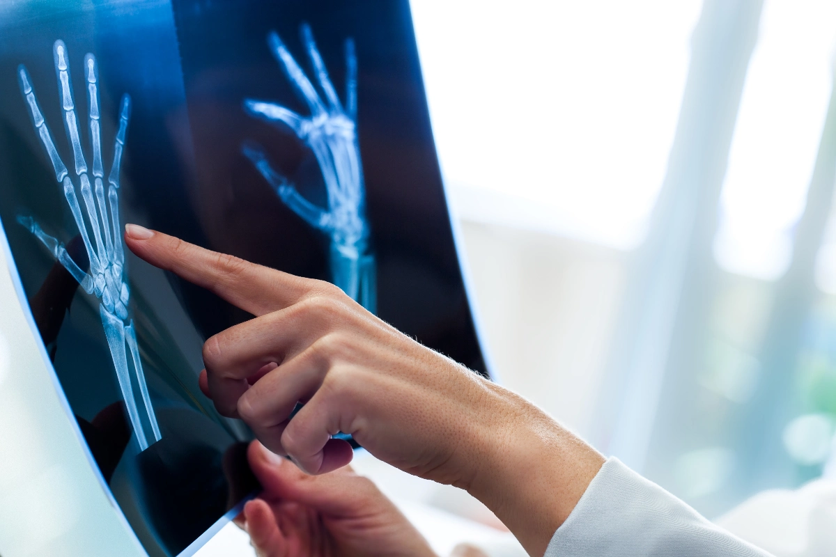 A doctor points at a hand X-ray on a lightbox, examining the bones. The atmosphere is clinical and focused, suggesting medical analysis. Bone Grafting for Hand & Wrist Dr. Rod French Vancouver