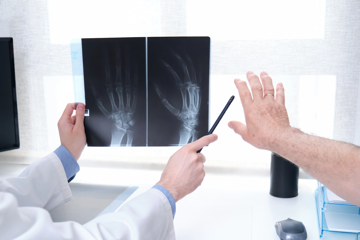 A doctor holds and points at hand X-rays with a pen, while a patient's hand is raised nearby. Bright, clinical setting, highlighting medical analysis. Hemi-hamate Arthroplasty Specialist Dr. Rod French