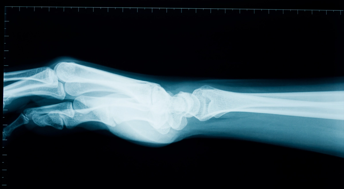 x-ray of wrist and forearm. Wrist Arthroscopy in Vancouver Dr. Rod French